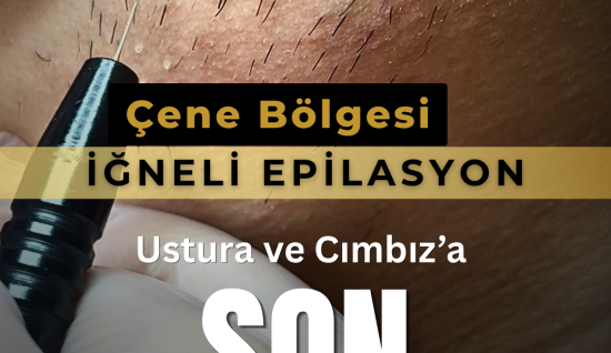 Yaz Aylarında İğneli Epilasyon Yapılır mı?