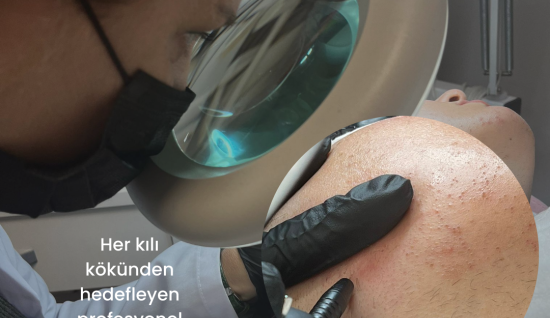 Kurtköyde Yüz Bölgesi İğneli Epilasyon  Lazerin Etki Etmediği Tüylerde Net Sonuç